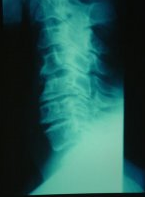Radiographie standard de la colonne cervicale de profil. {JPEG}