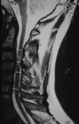 IRM en séquence pondérée en T2 avec mensurations du canal cervical. En regard de C3/C4 : sténose importante du canal rachidien, disparition de l'hypersignal du LCR en avant et en arrière de la moelle, hypersignal spontané de la moelle {PNG}