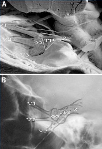 Système trigéminal sur une dissection anatomique de Klingler (A) et sa projection sur la radiographie du crâne en vue latérale (B). {JPEG}