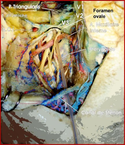 Dissection anatomique de la voie transjugoforaminale ovale (du côté droit) {JPEG}