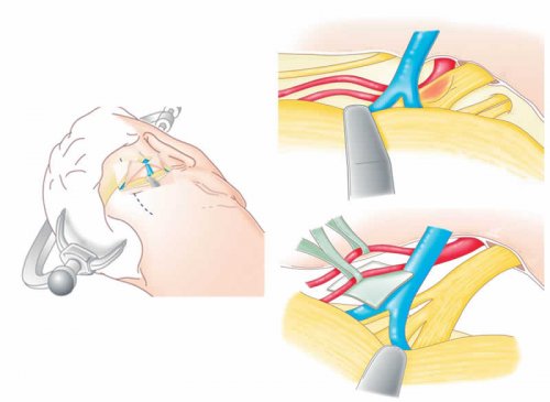 Principe de la Décompression vasculaire microchirurgicale pour conflit neurovasculaire à partir de l'artère cérébelleuse supérieure {JPEG}